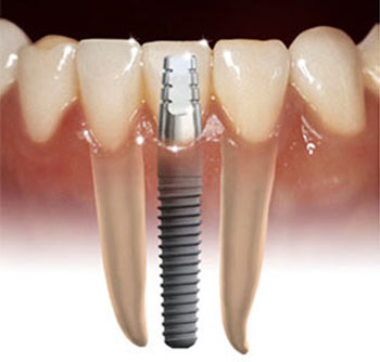 best dental clinics Adyar, Chrompet,triplicane, omr, ecr, Chennai