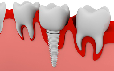 chennai Tooth Replacement