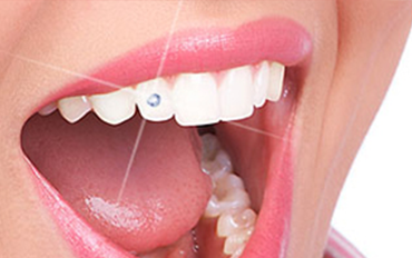 Dental Jewellery in chennai
