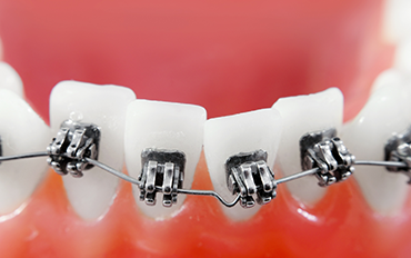 Chennai Orthodontist