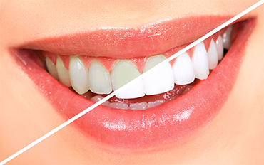 Teeth whitening in chennai